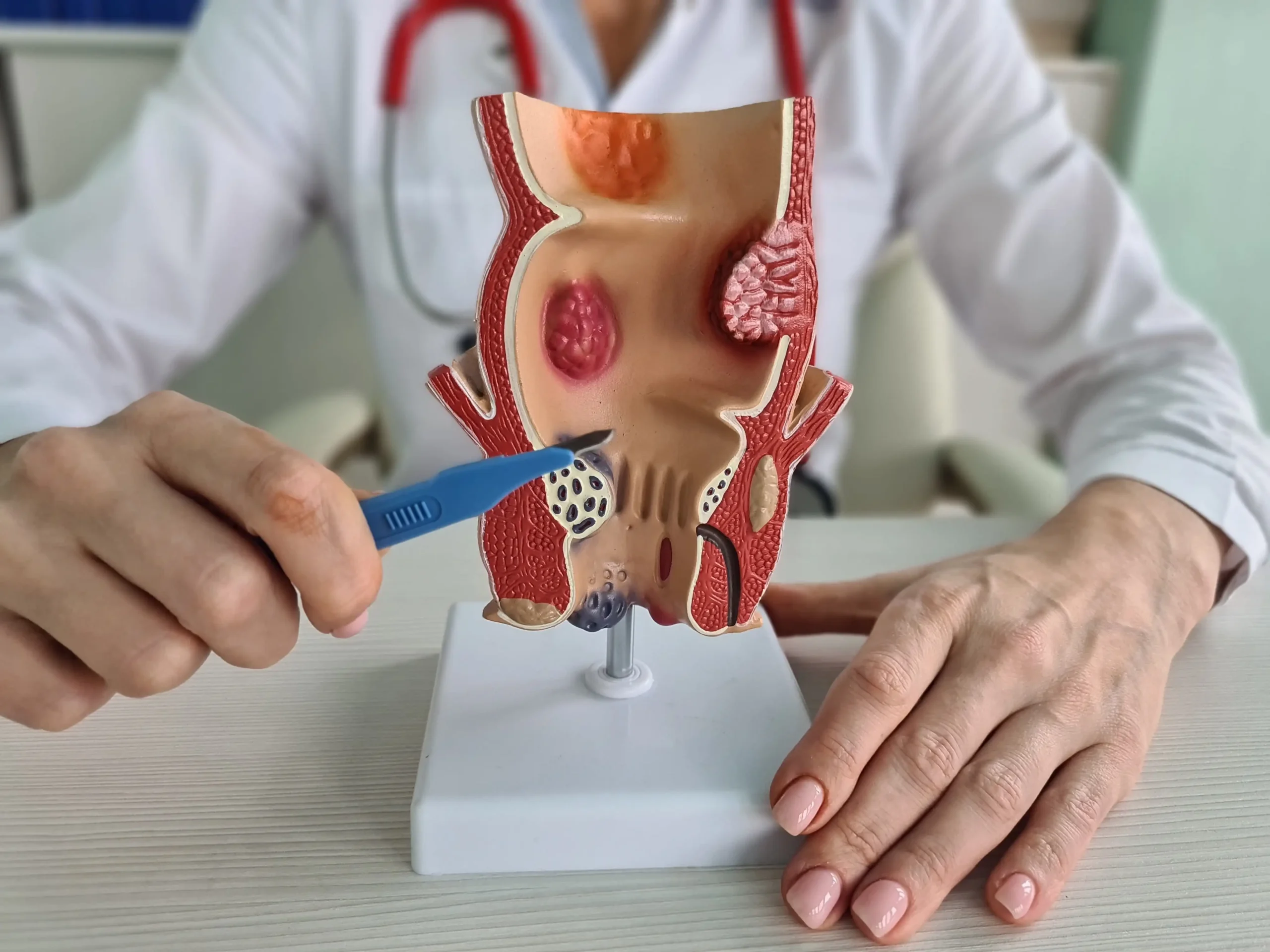 علاج البواسير في عمان بدون الم وبالطرق الحديثة