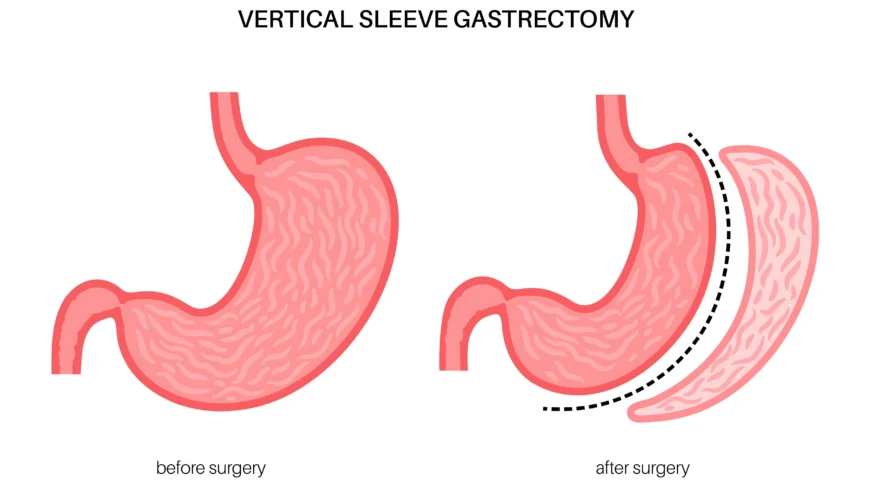 افضل دكتور تكميم في الاردن تكميم المعدة بالمنظار جراحة السمنة في الاردن