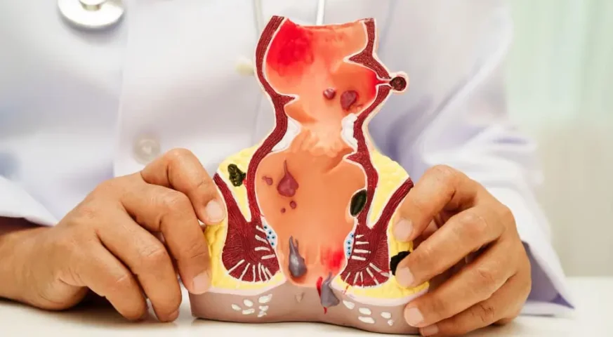 عملية الباسور بدون ألم جراحة البواسير بدون ألم علاج البواسير بالليزر