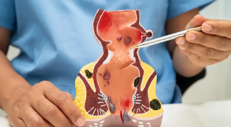 افضل دكتور لعلاج الناسور في عمان عملية الناسور الشرجي في الاردن