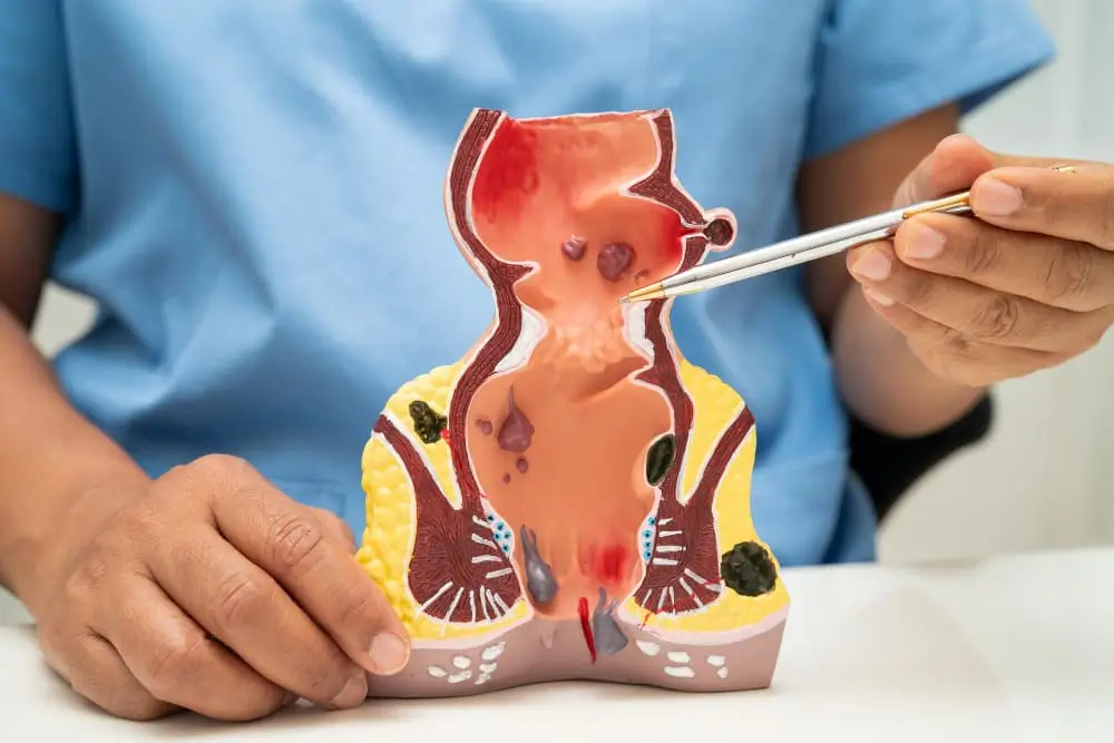 افضل دكتور لعلاج الناسور في عمان عملية الناسور الشرجي في الاردن