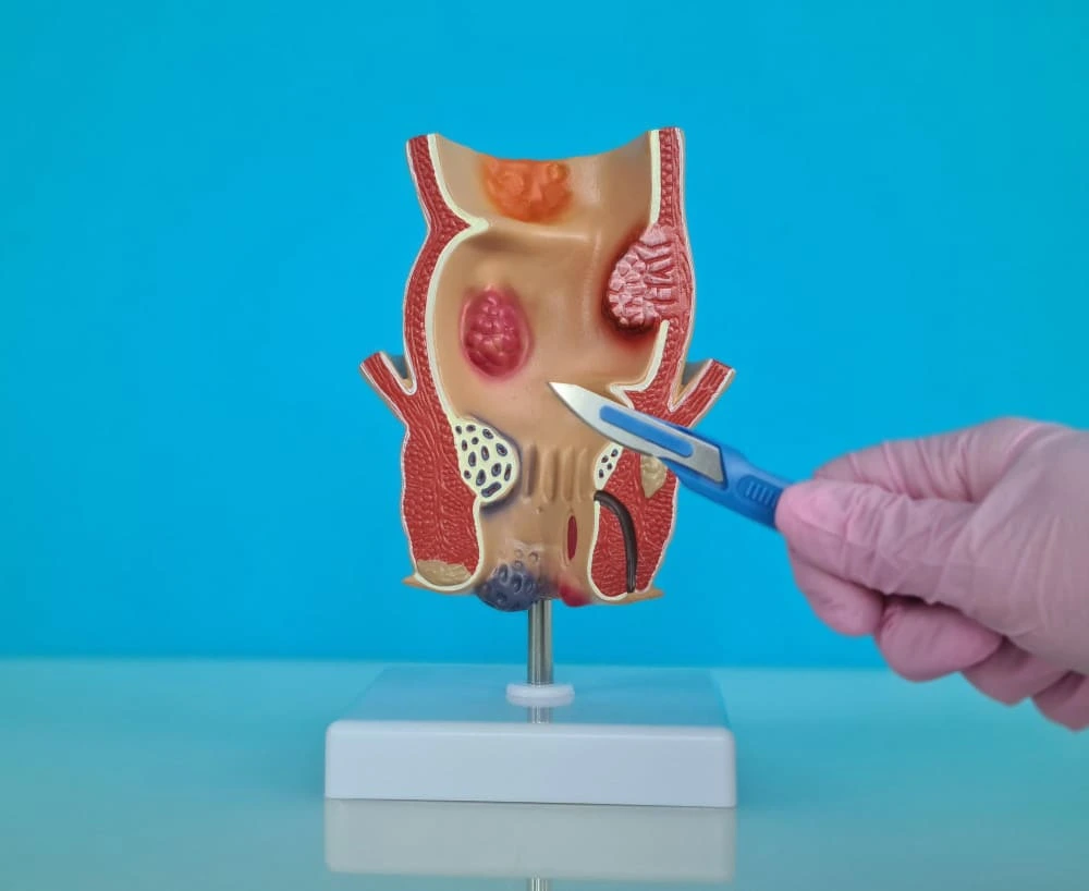 الفرق بين البواسير والناسور اعراض الناسور الشرجي