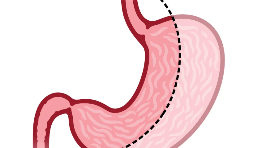 تكميم المعدة في عمان، عملية تكميم المعدة في الاردن