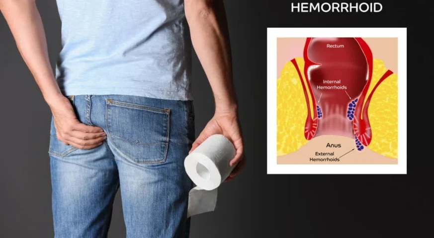 الفرق بين الباسور و الناسور اعراض البواسير اعراض الناسور الشرجي