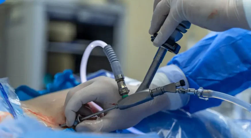 عملية الفتق بالمنظار جراحة الفتق بالمنظار إصلاح الفتق الإربي بالمنظار