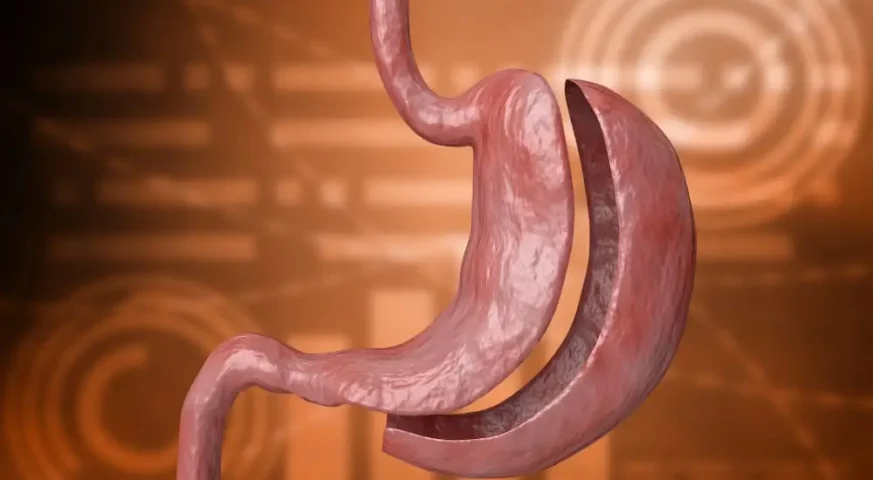 عملية تكميم المعدة شروط تكميم المعدة جراحة السمنة