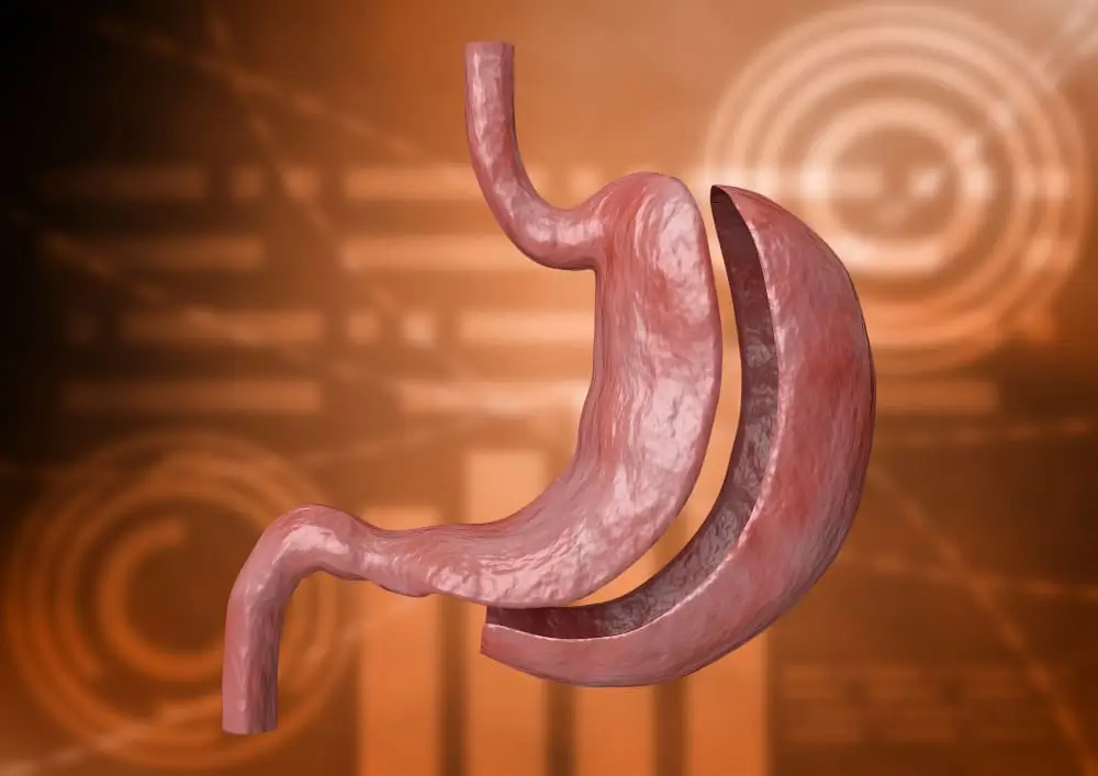 عملية تكميم المعدة شروط تكميم المعدة جراحة السمنة