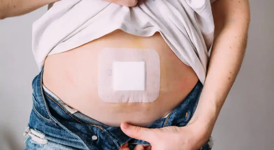 عملية فتق السرة عملية الفتق السري علاج فتق السرة الفتق السري عند الكبار