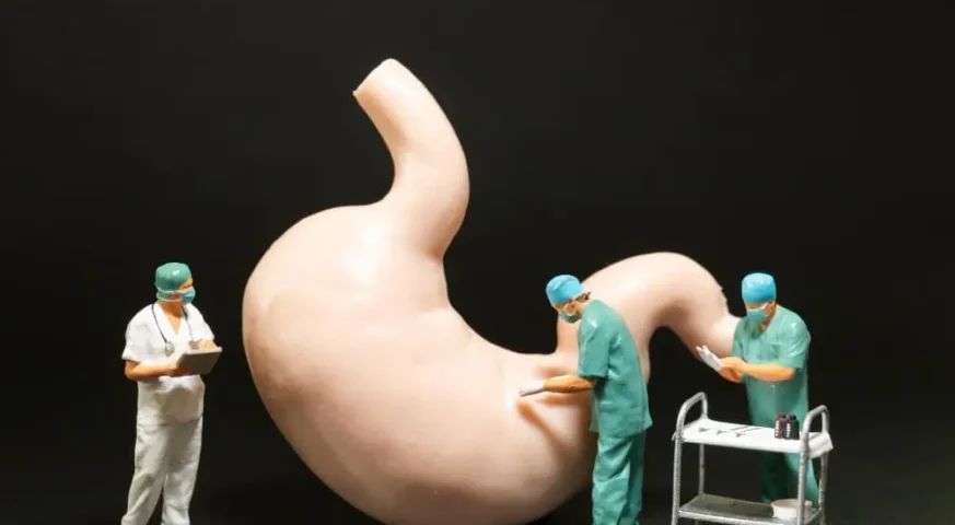 تكميم المعدة عملية تكميم المعدة تكميم المعدة بالمنظار قص المعدة