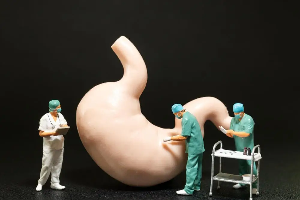 تكميم المعدة عملية تكميم المعدة تكميم المعدة بالمنظار قص المعدة